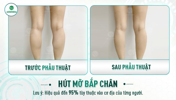 Review hút mỡ bắp chân