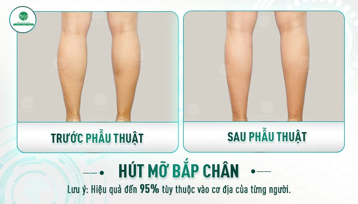 Review hút mỡ bắp chân