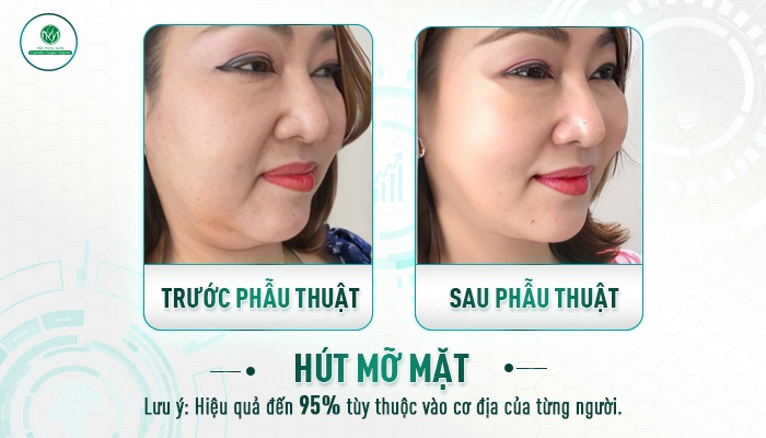 Review hút mỡ nọng cằm