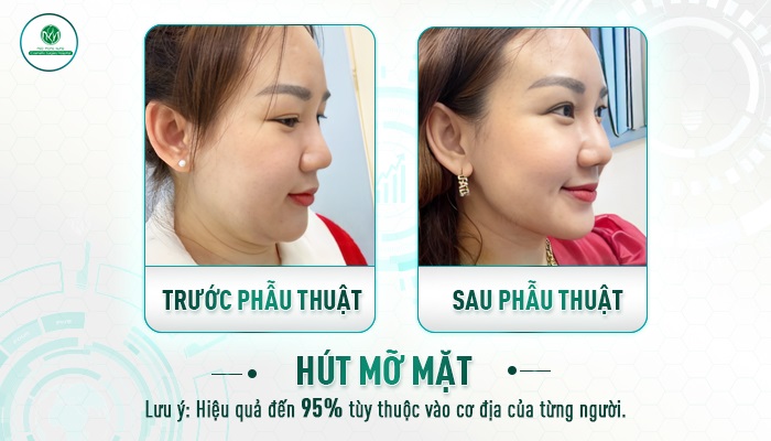 Review hút mỡ nọng cằm