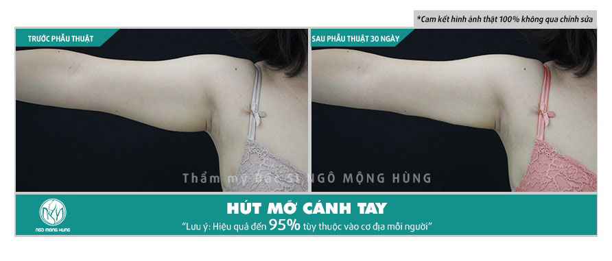 có nên hút mỡ bắp tay