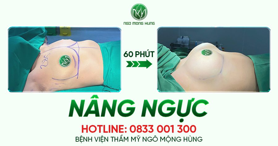 Nâng ngực