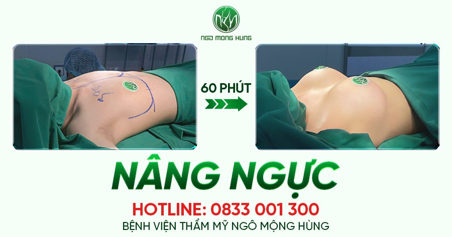 Nâng ngực