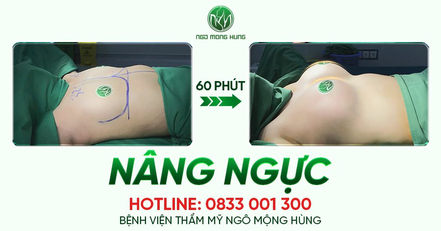 Nâng ngực