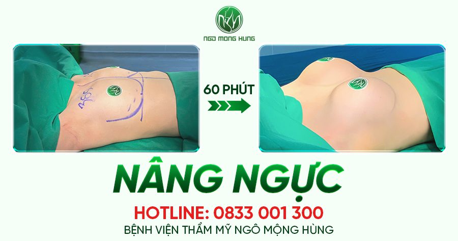 Nâng ngực