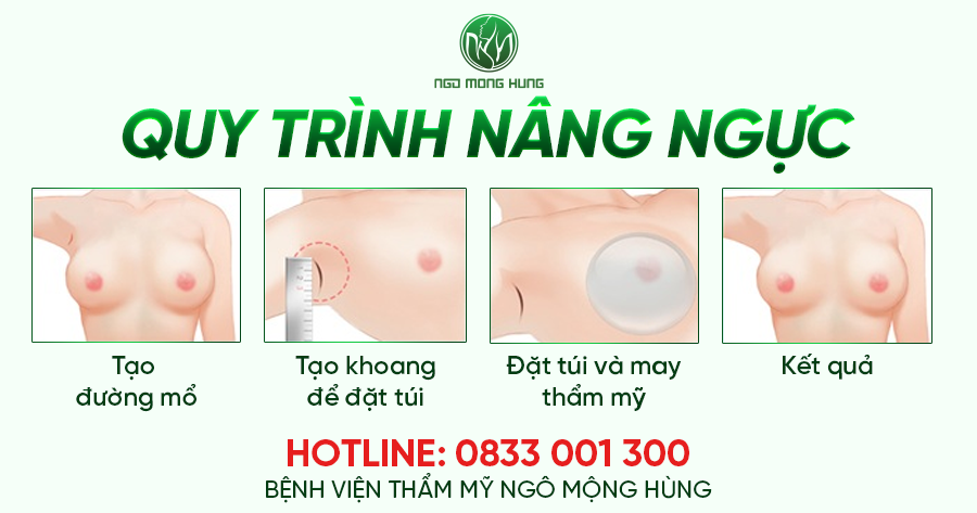 Nâng ngực