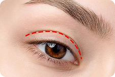 Cắt mí mắt có ảnh hưởng đến thị lực không?