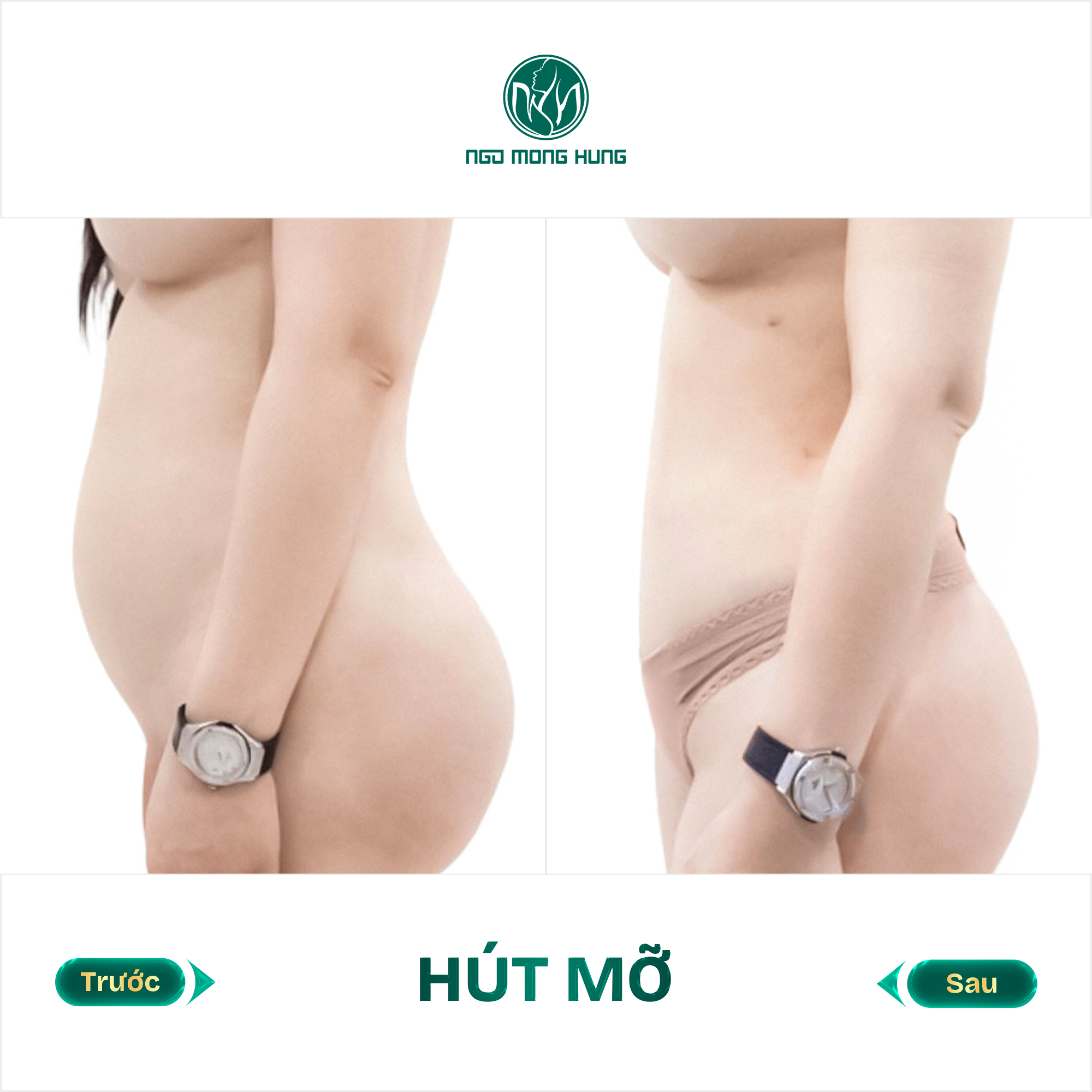 hút mỡ bụng