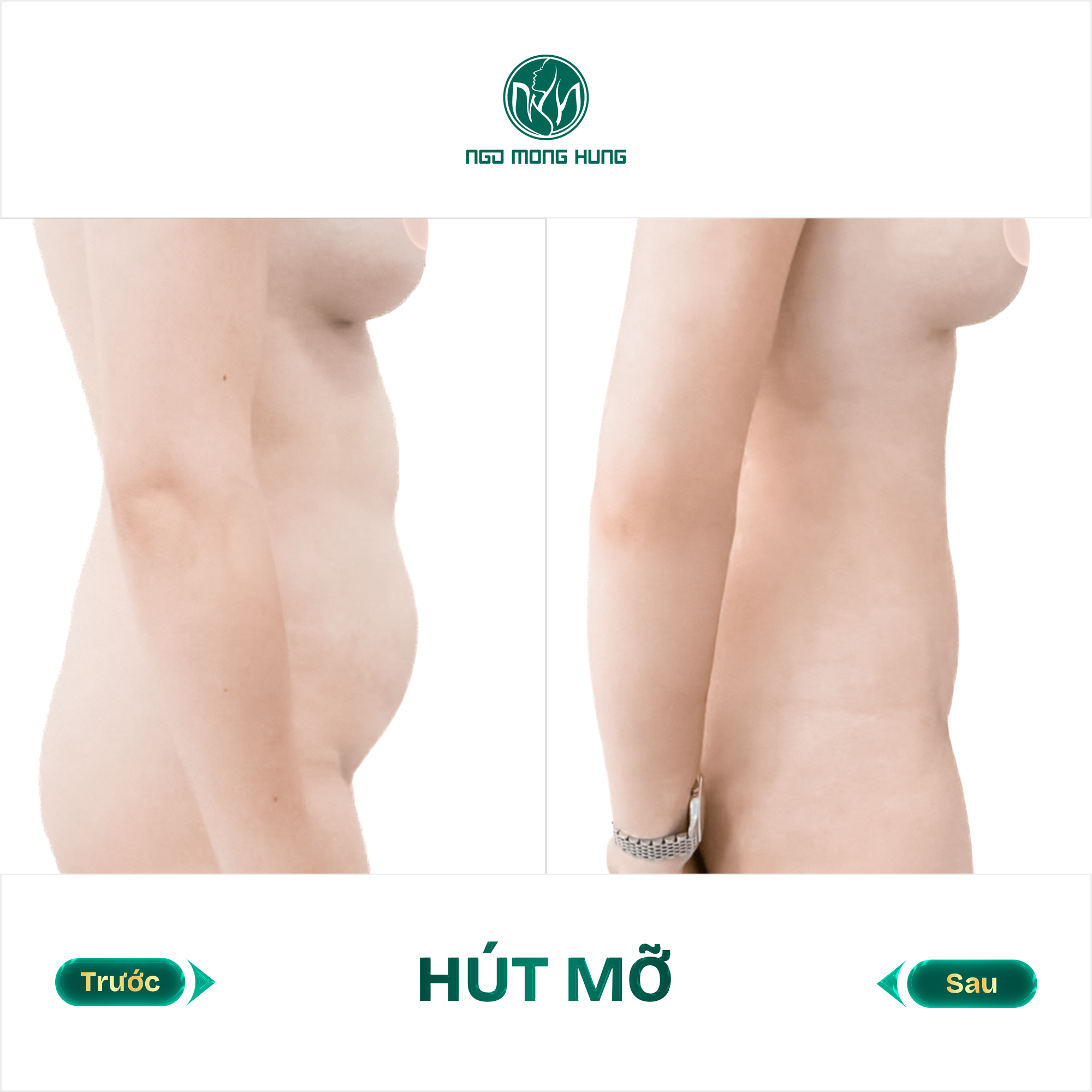 hút mỡ bụng