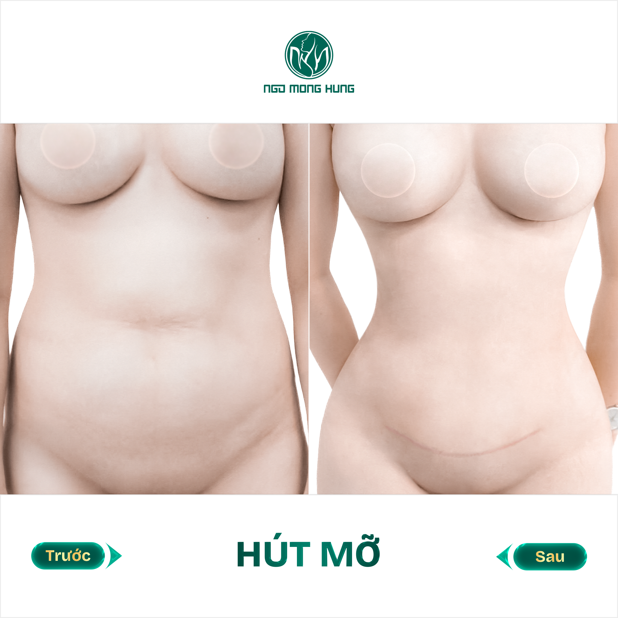 hút mỡ bụng