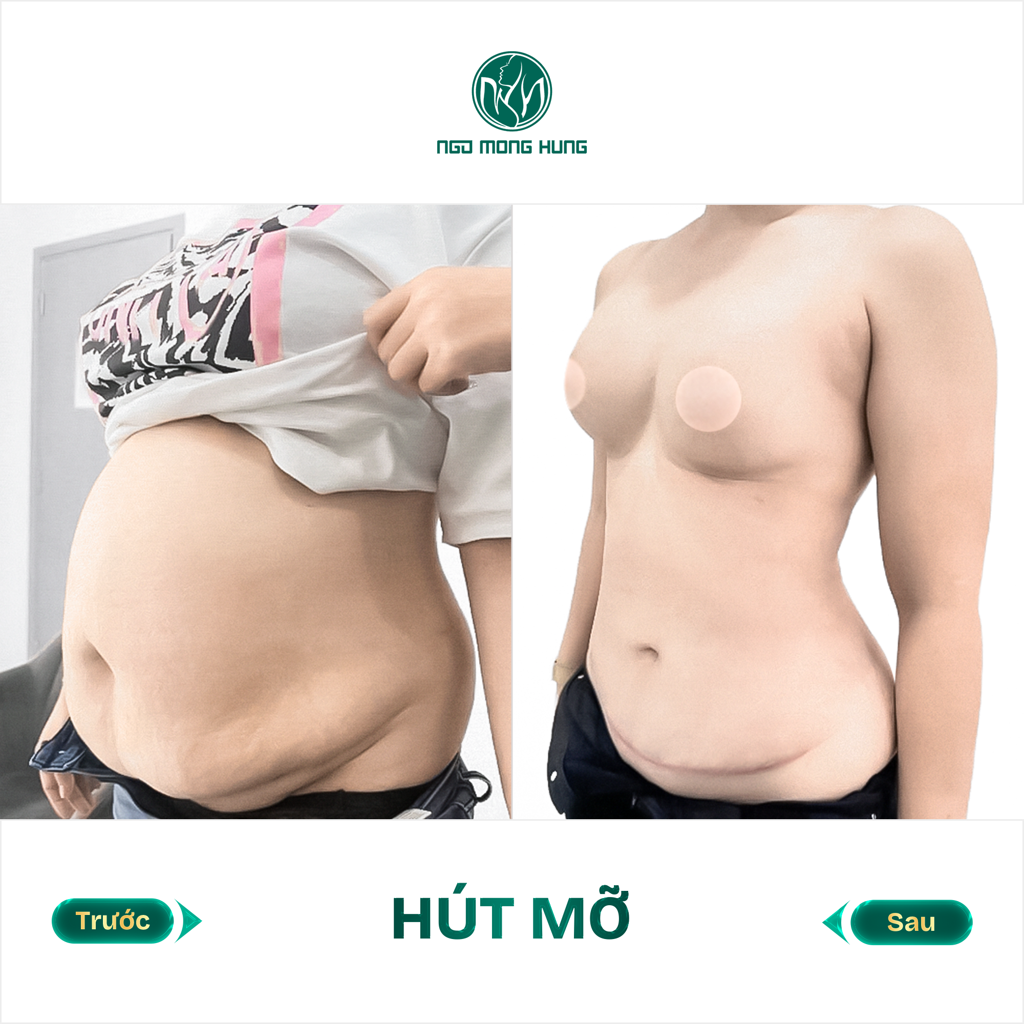 hút mỡ bụng