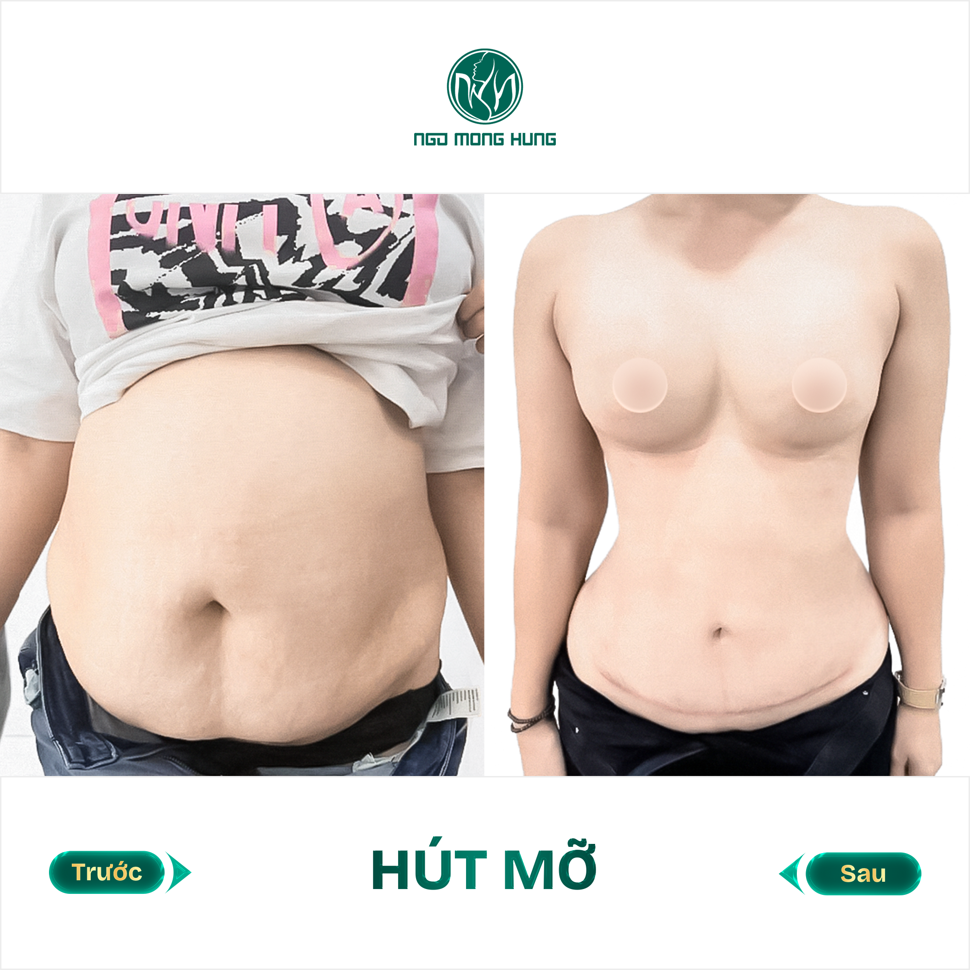 hút mỡ bụng
