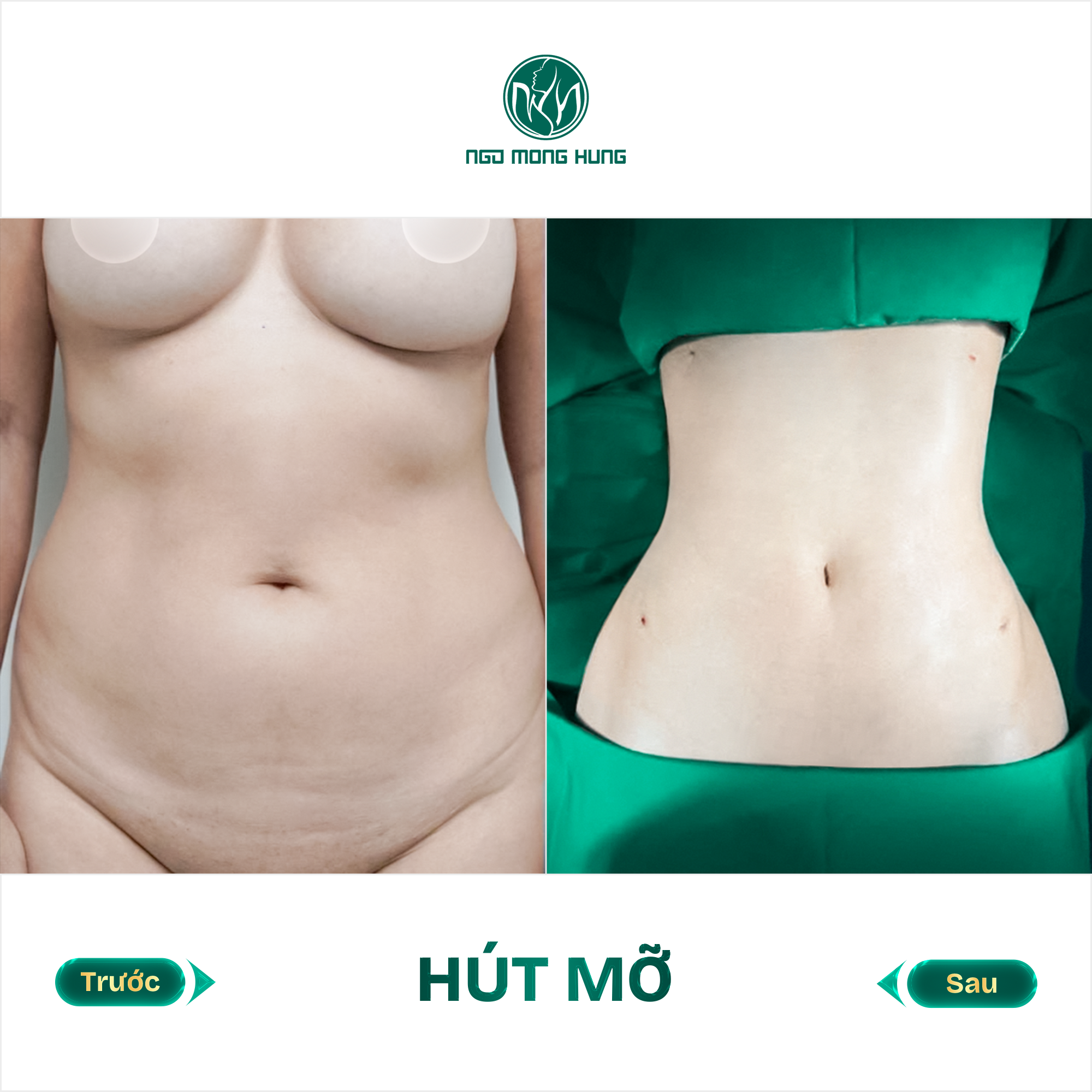 hút mỡ bụng
