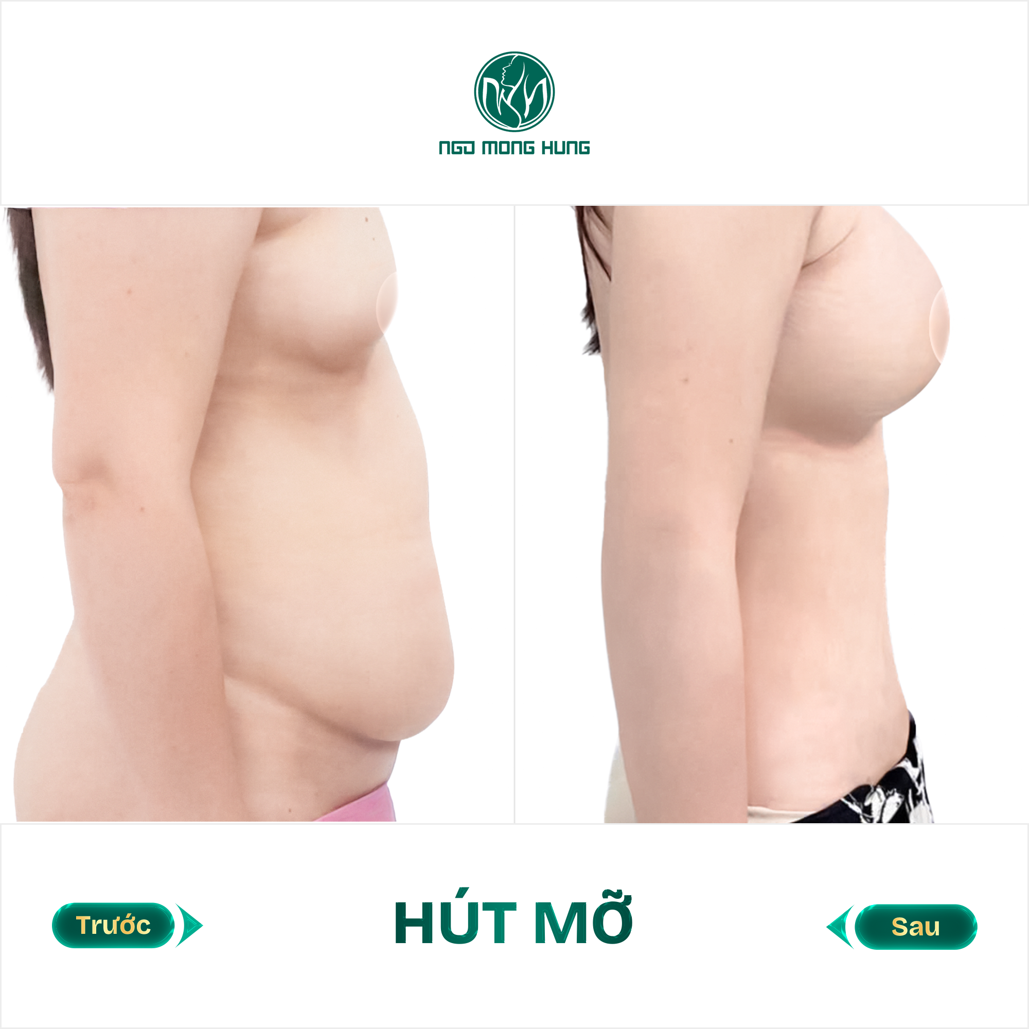 hút mỡ bụng