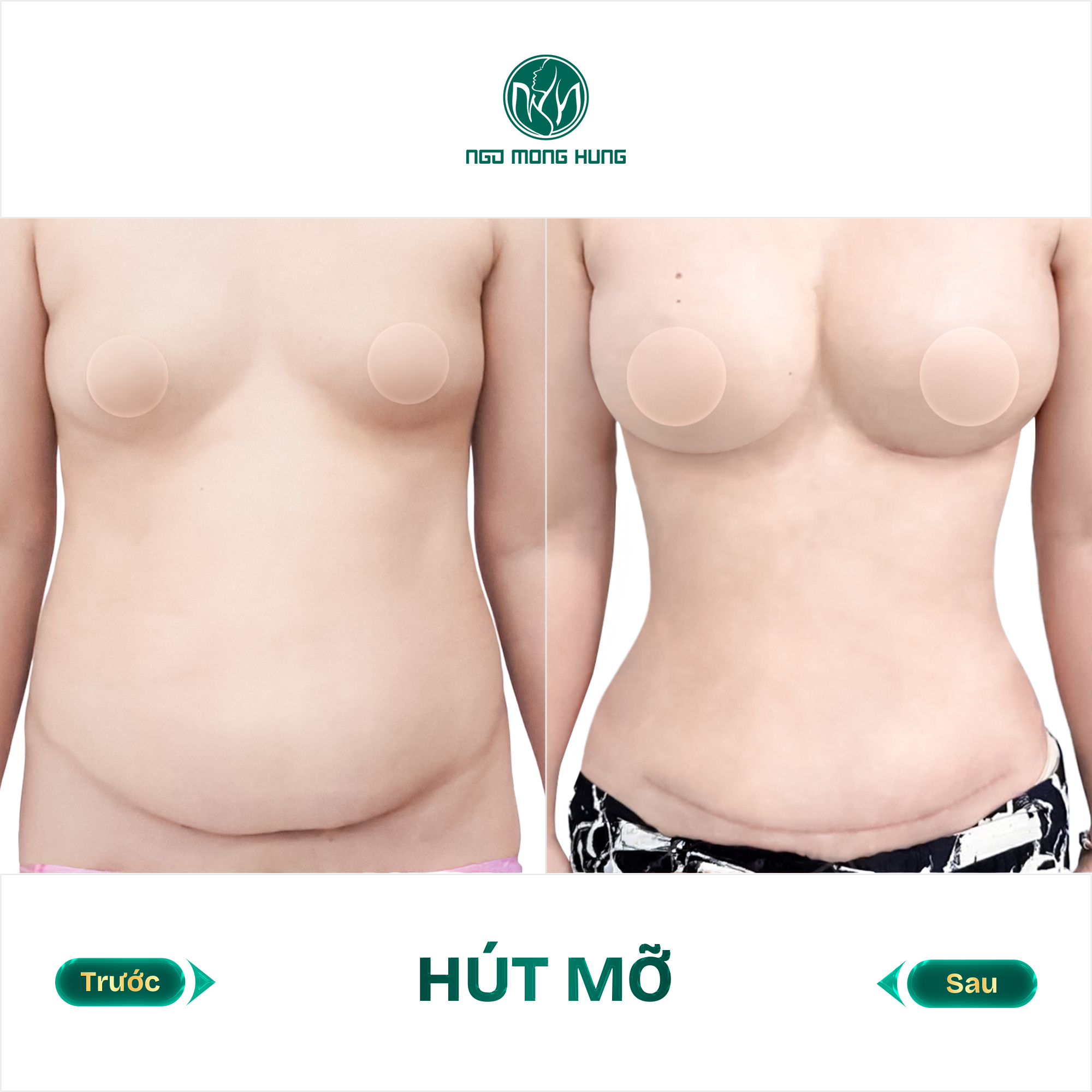 hút mỡ bụng