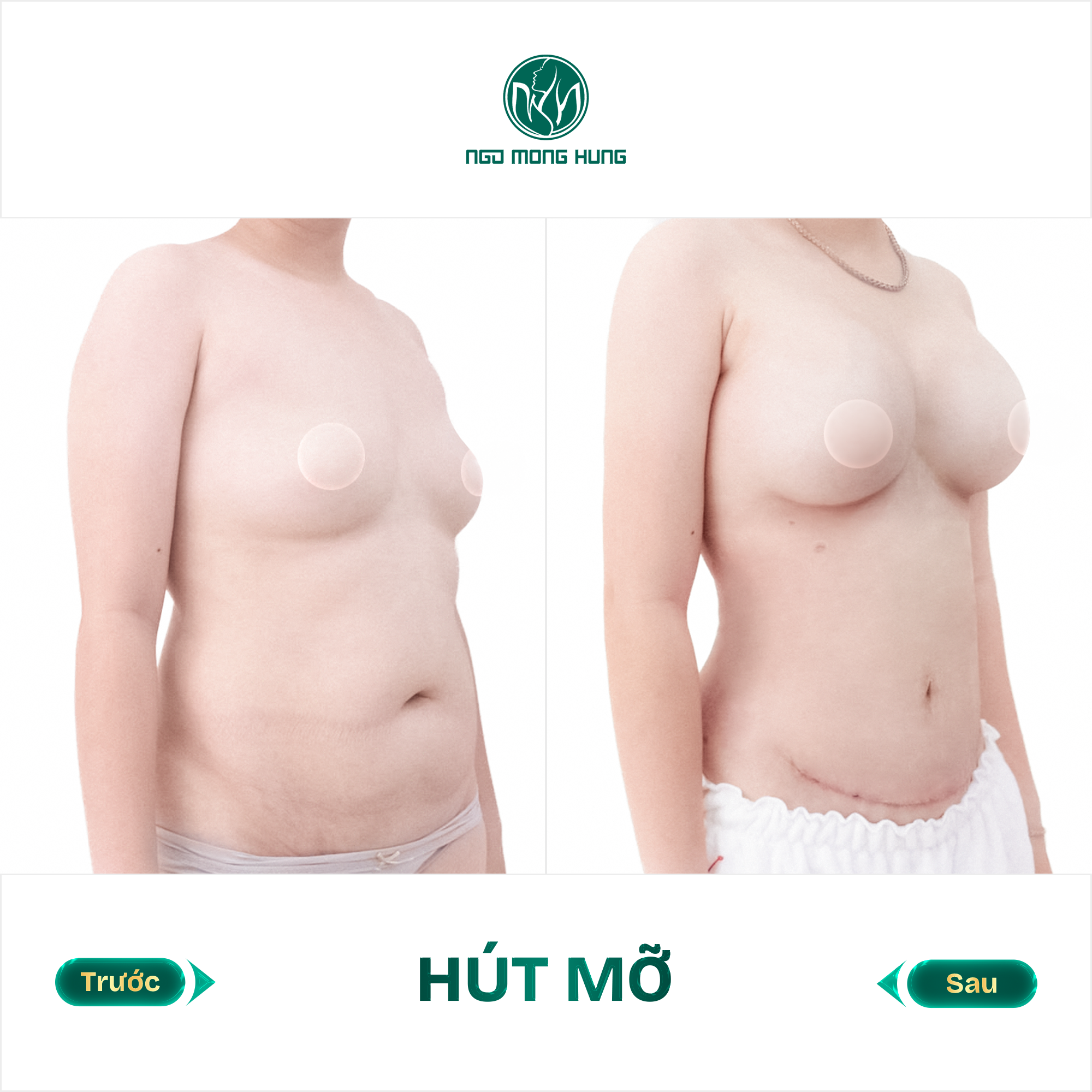 hút mỡ bụng