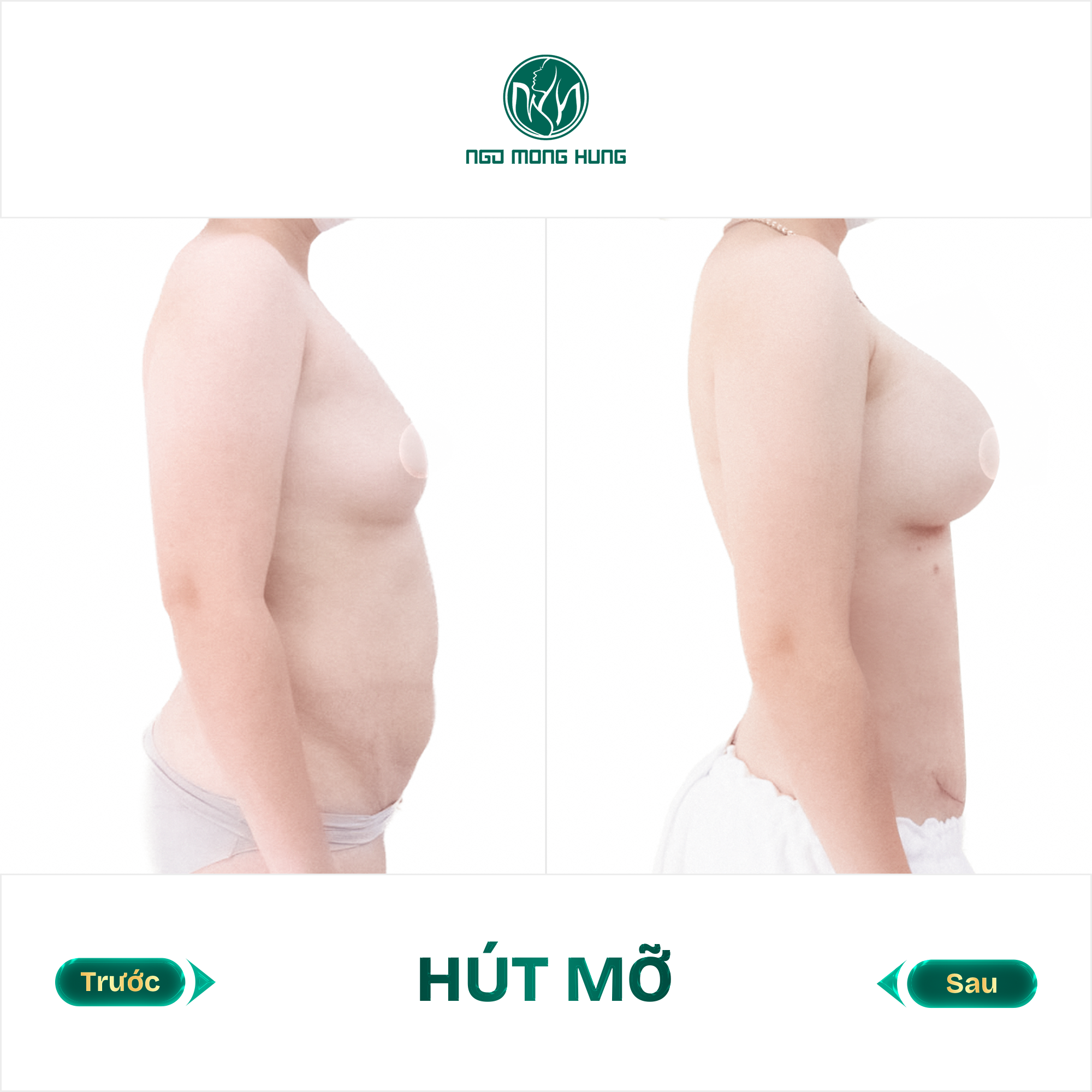 hút mỡ bụng