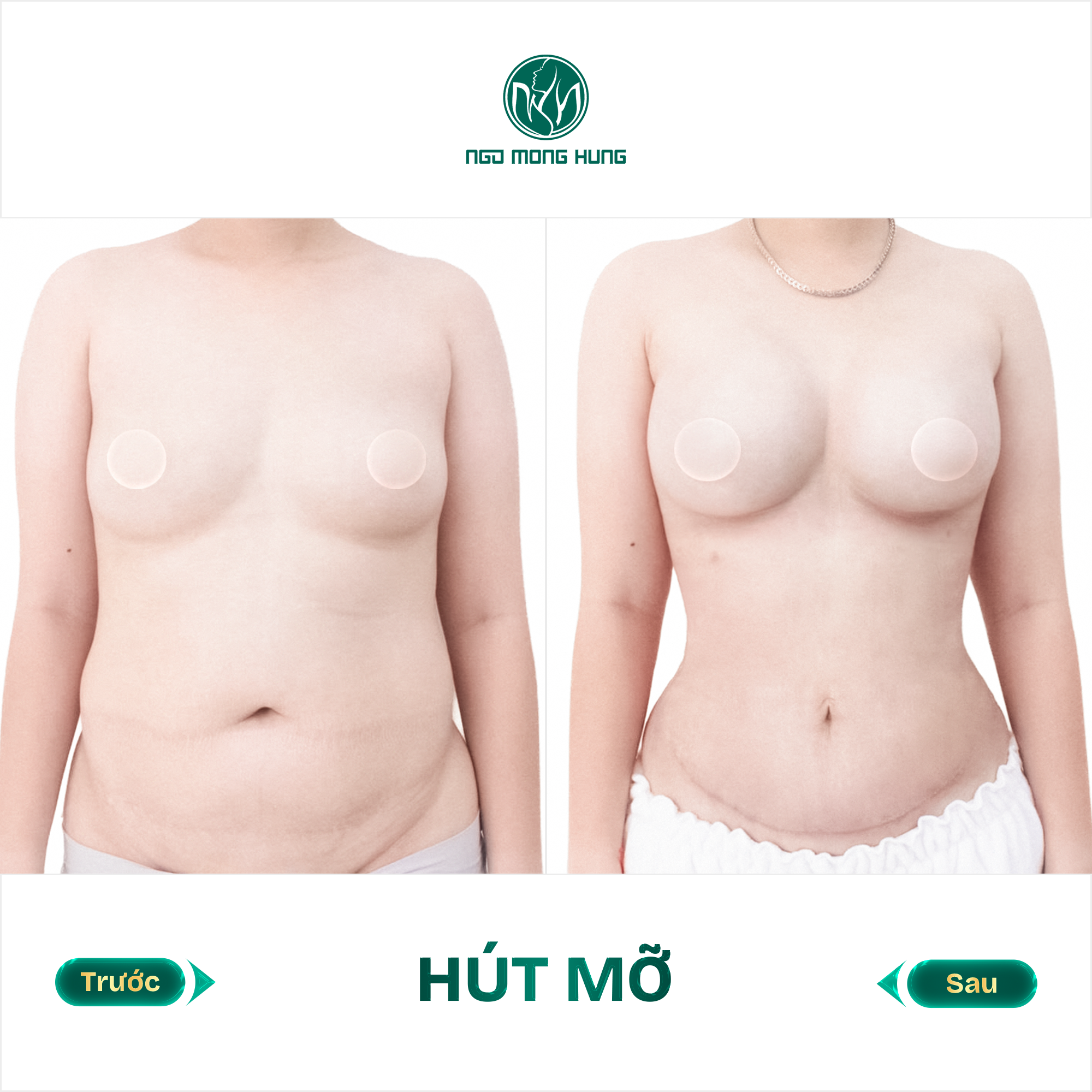 hút mỡ bụng
