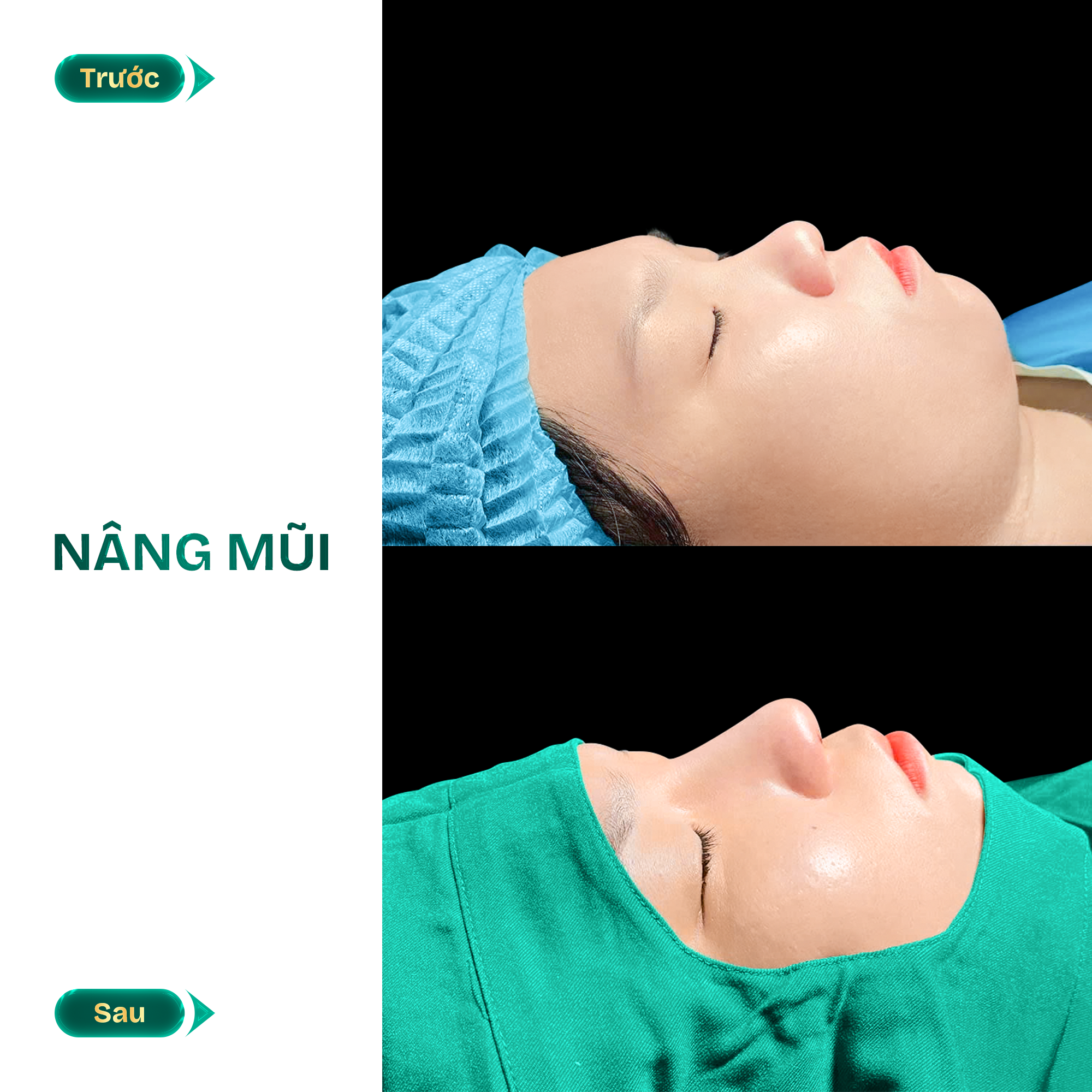 hình ảnh nâng mũi
