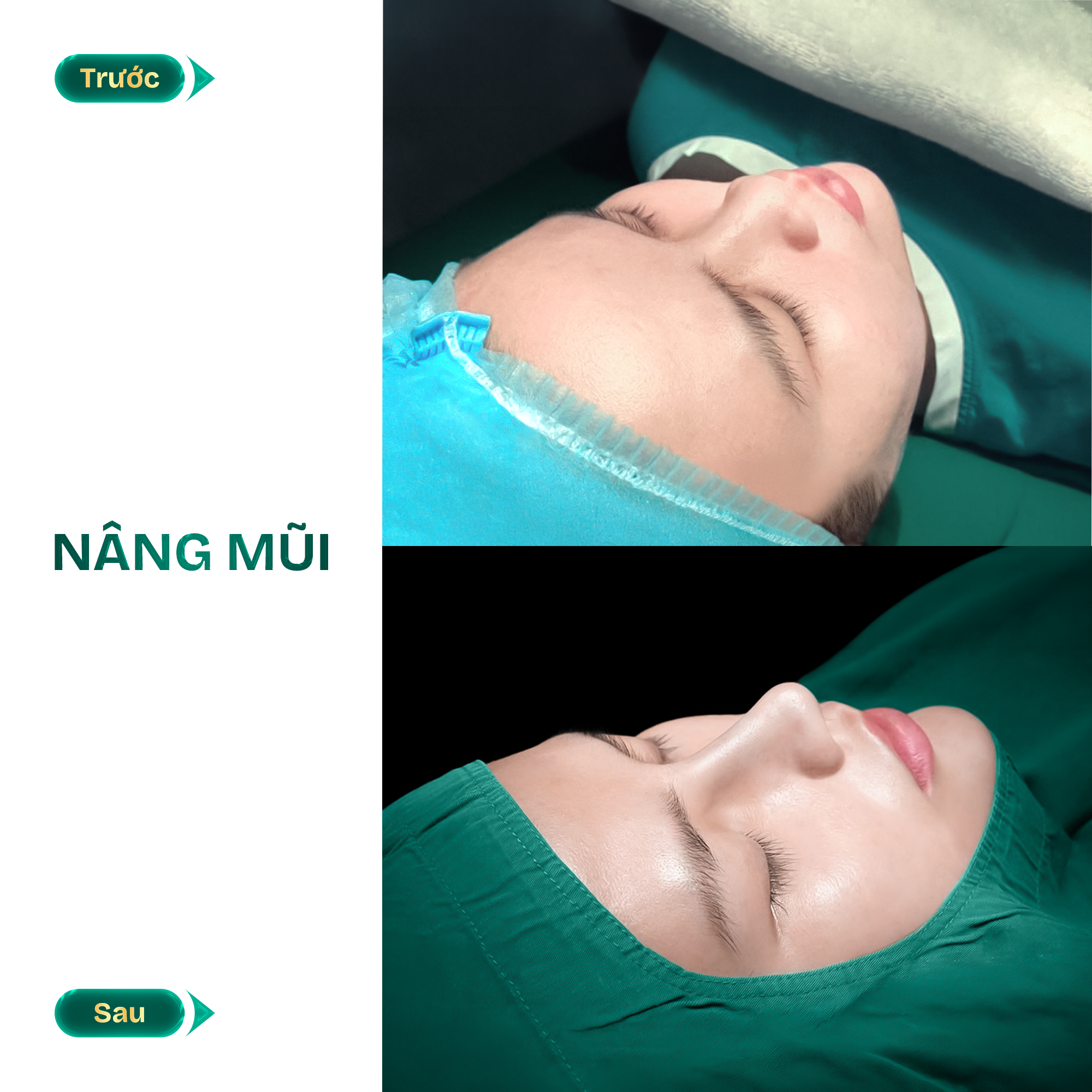 hình ảnh nâng mũi