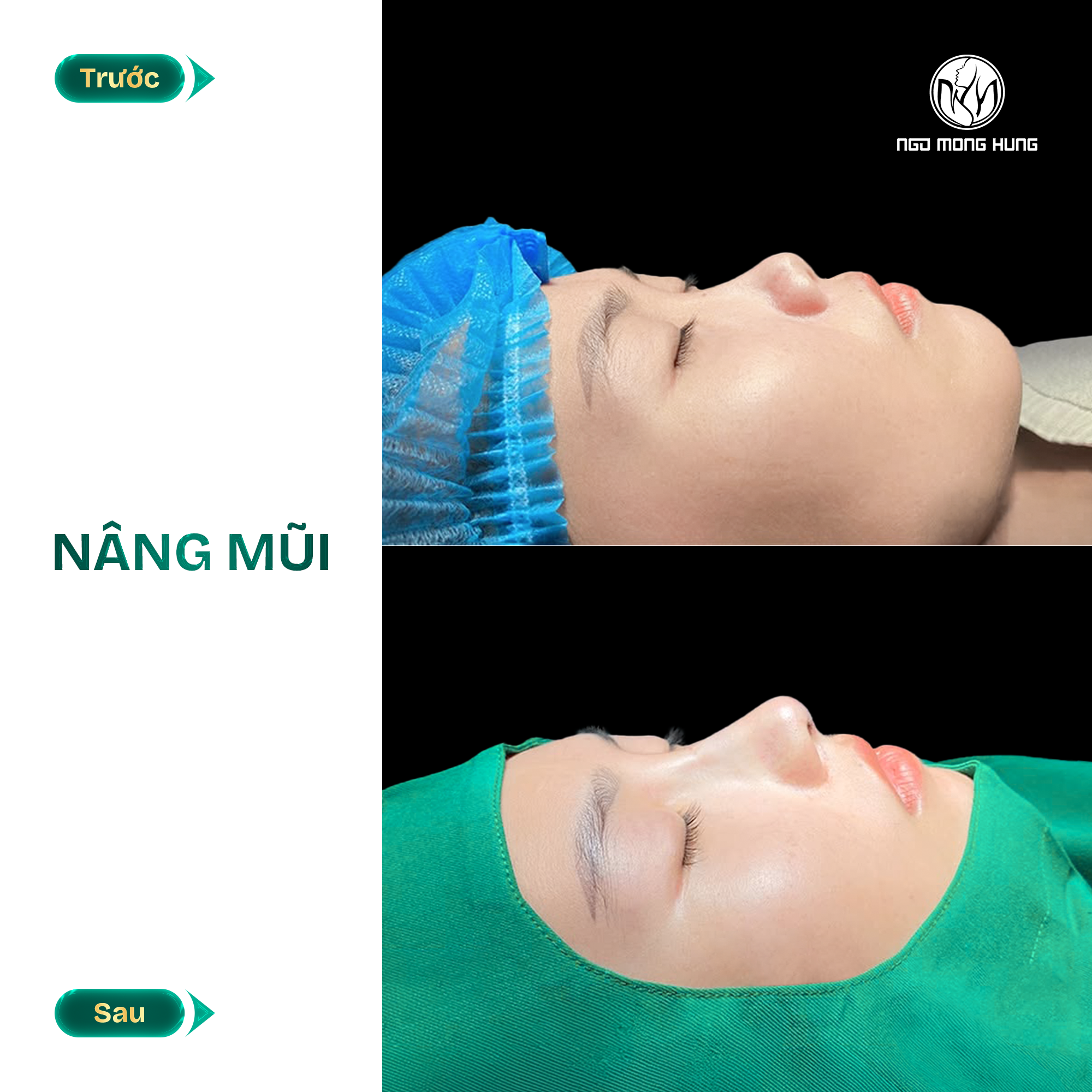 hình ảnh nâng mũi