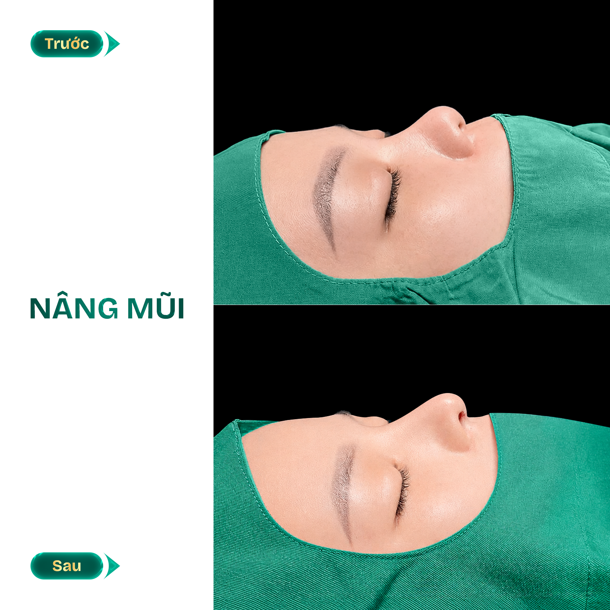 hình ảnh nâng mũi