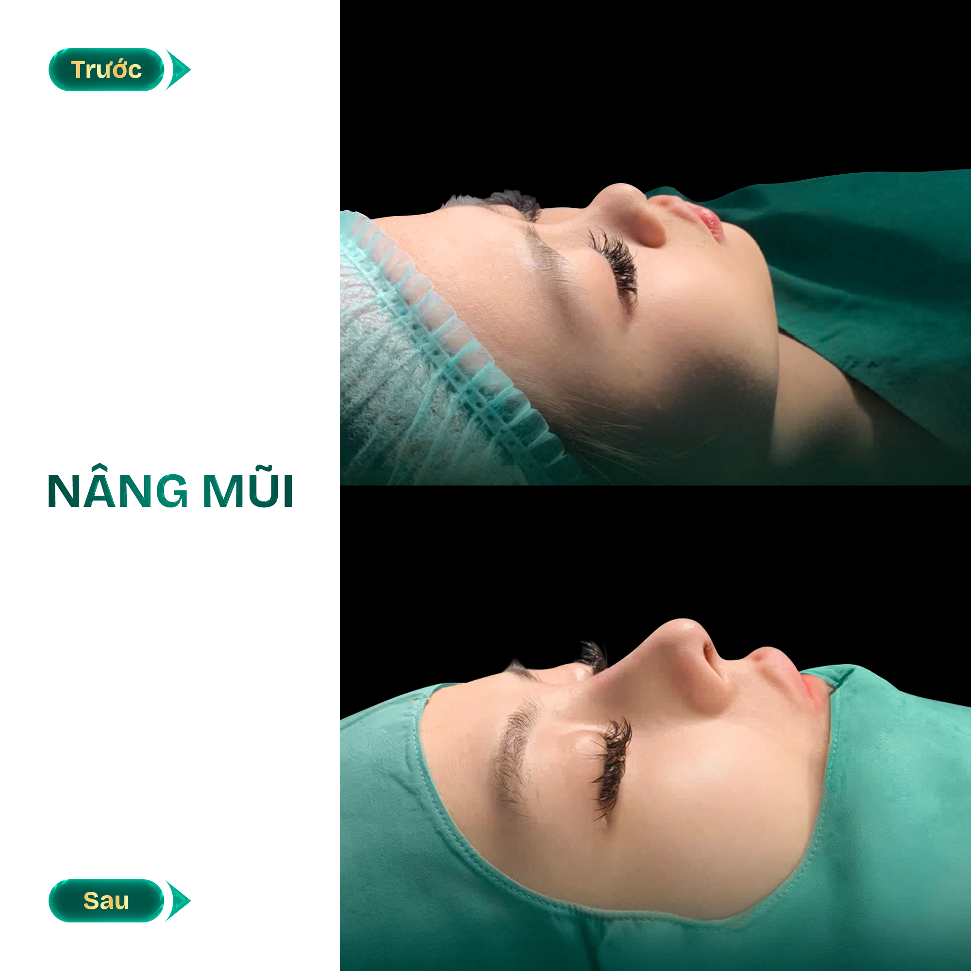 hình ảnh nâng mũi