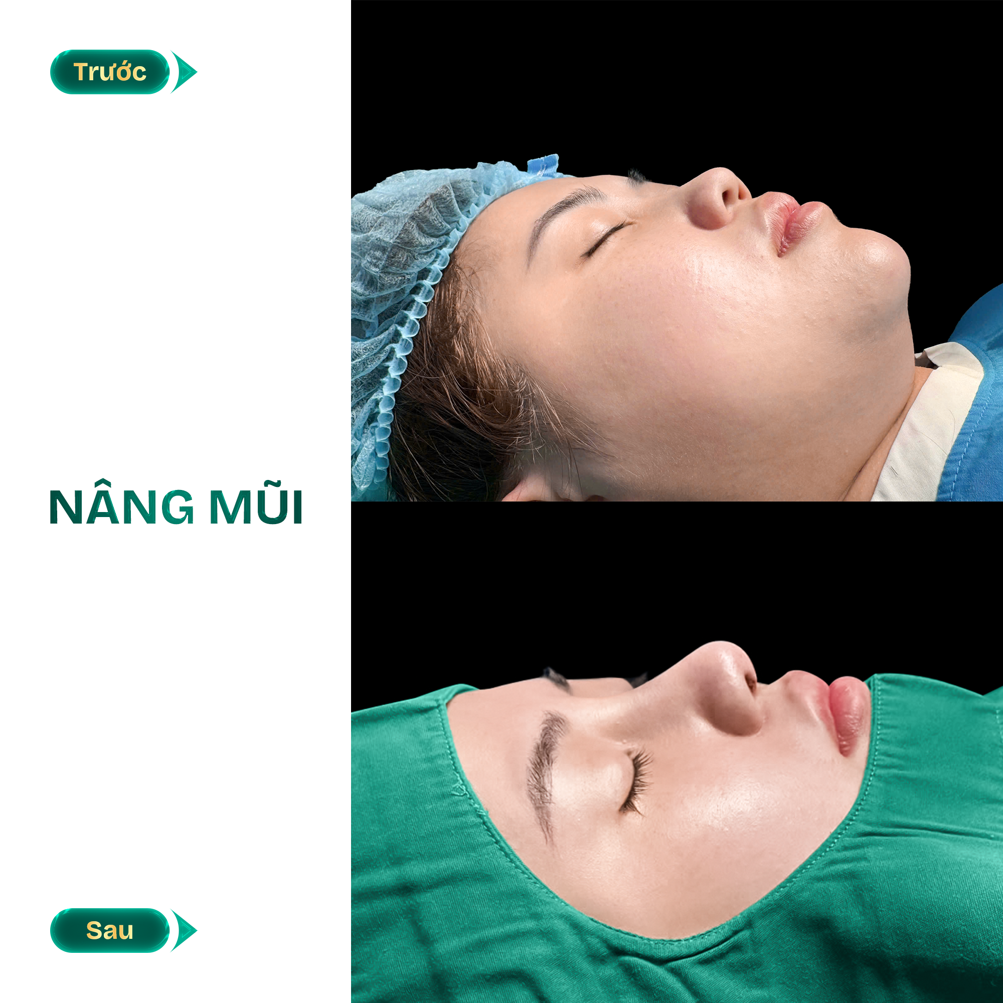 hình ảnh nâng mũi