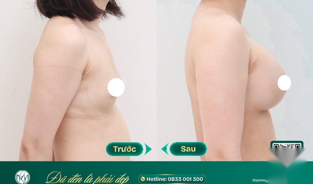 Làm hồng nhũ hoa