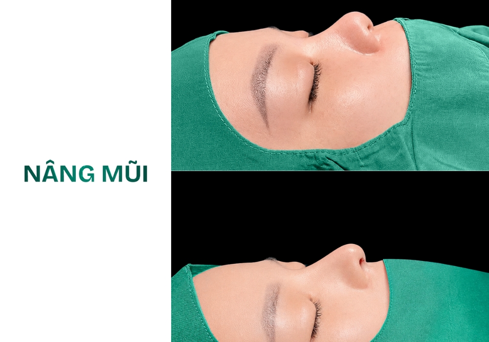nâng mũi s line