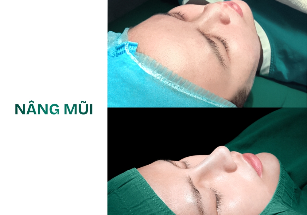 nâng mũi s line