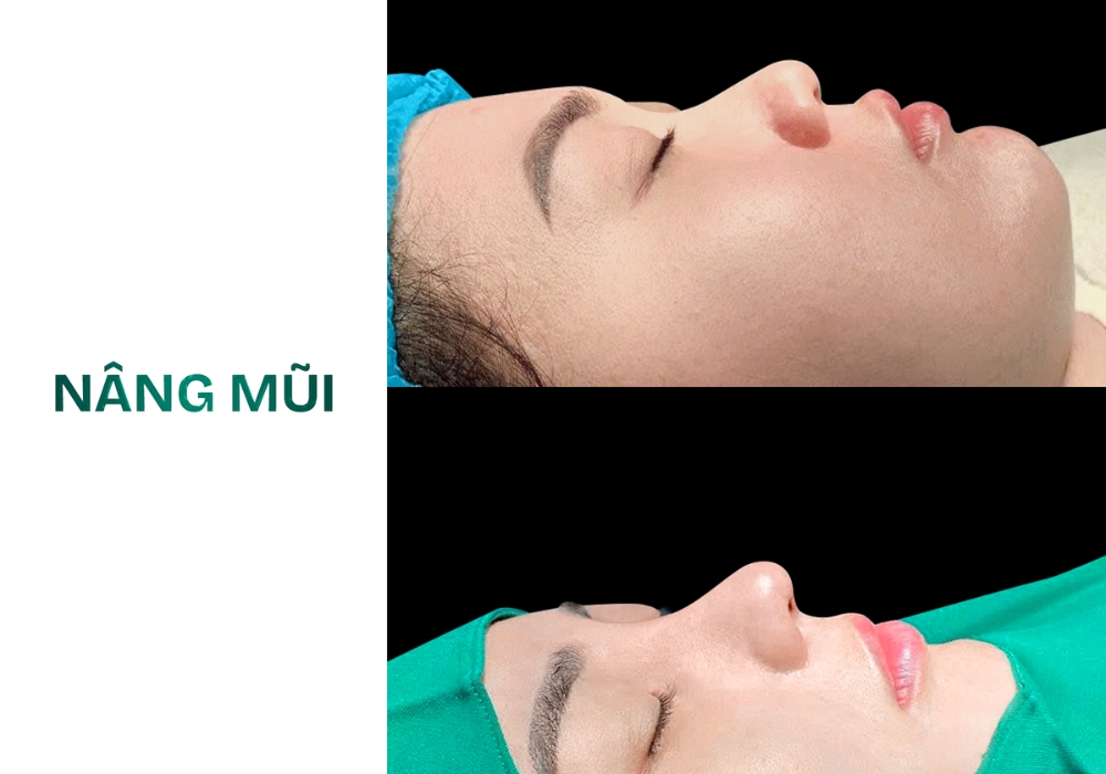 nâng mũi s line
