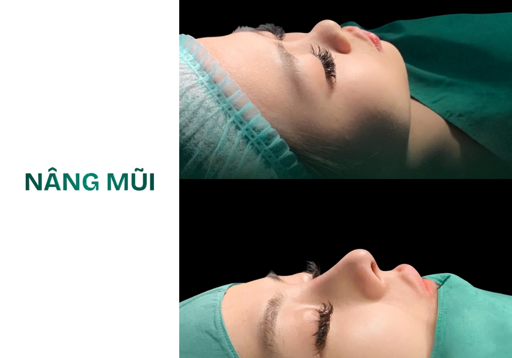 nâng mũi s line