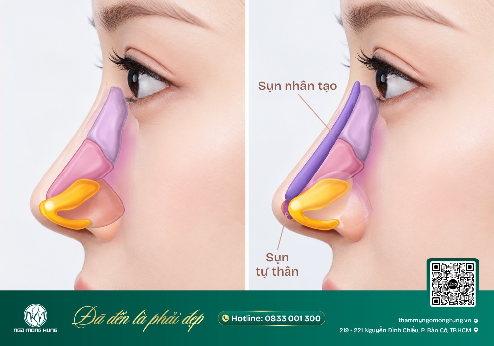nâng mũi tự nhiên