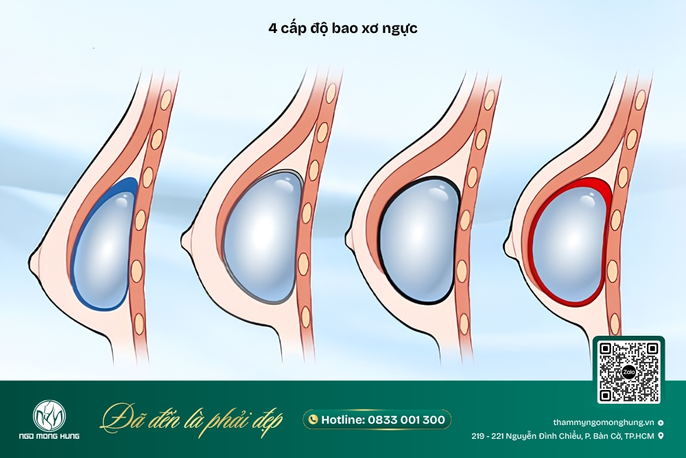 nâng ngực bị hỏng