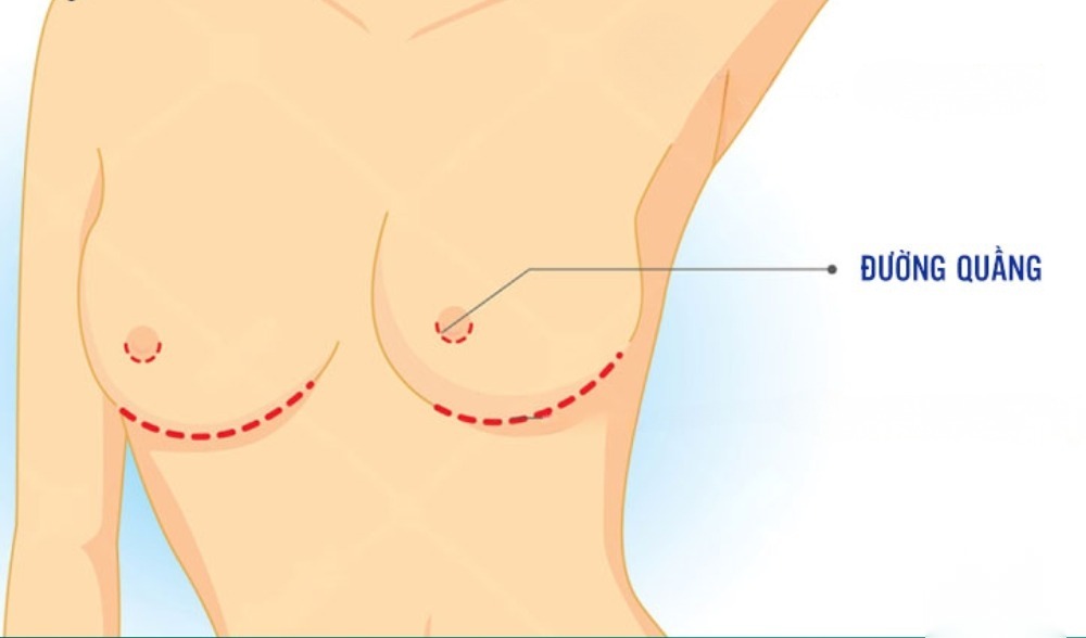 Nâng ngực đường nách