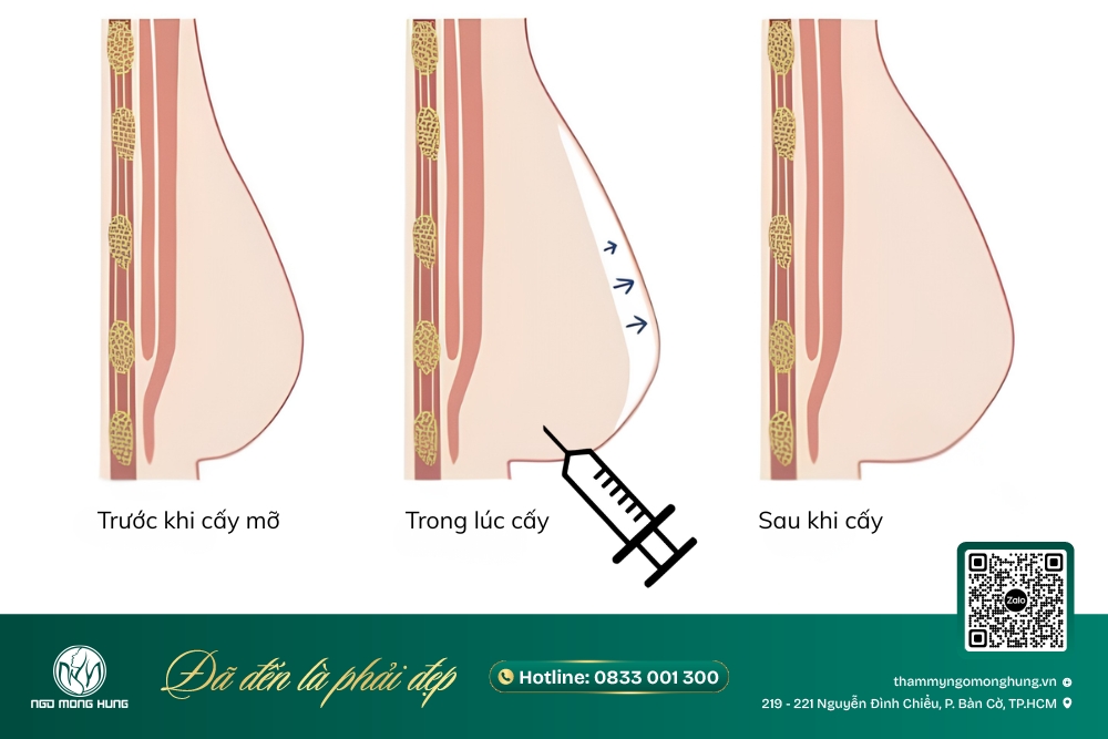 nâng ngực lấy mỡ tự thân