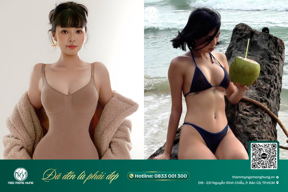 nâng ngực lấy mỡ tự thân