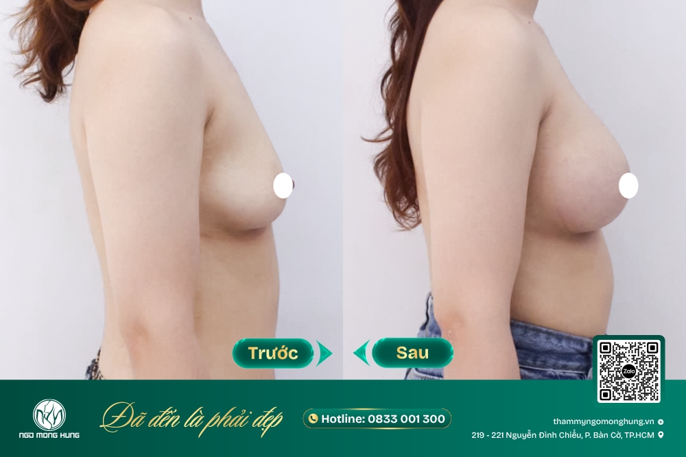 nâng ngực lấy mỡ tự thân