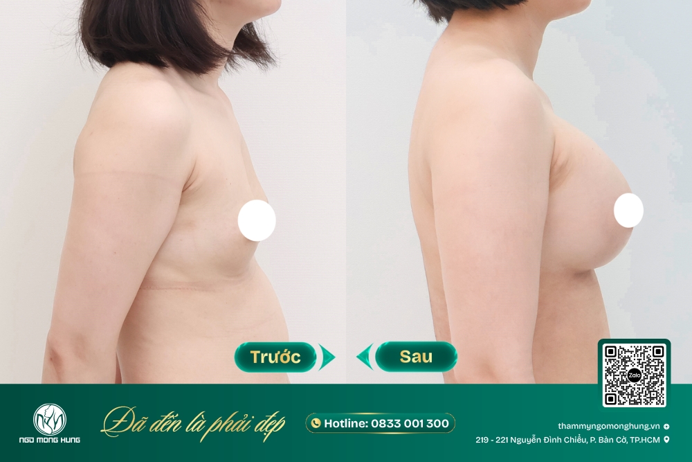 nâng ngực lấy mỡ tự thân