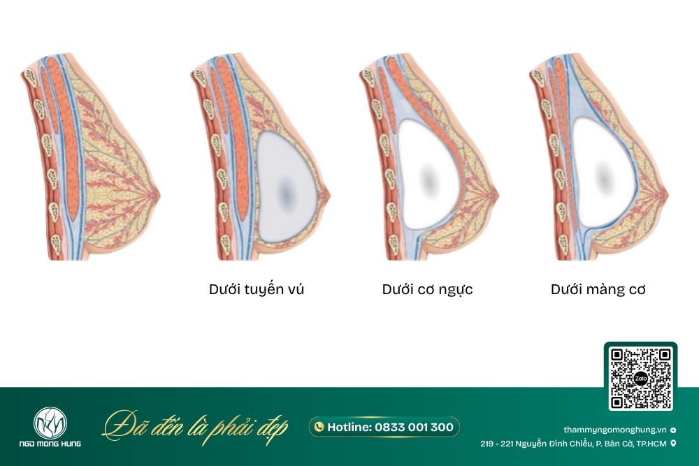 nâng ngực túi giọt nước