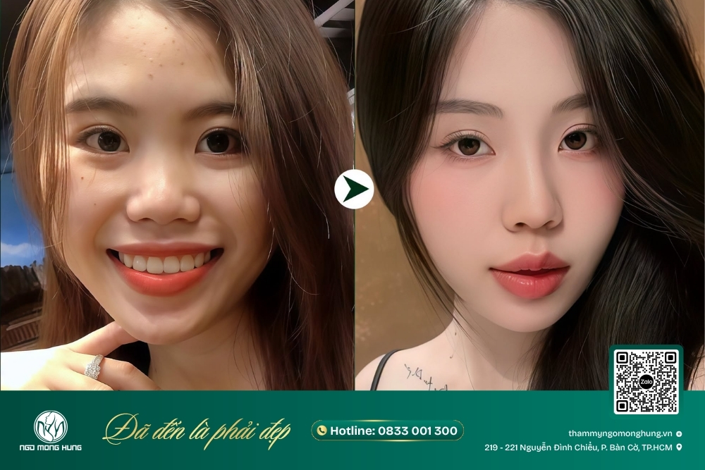 nâng sụn mũi