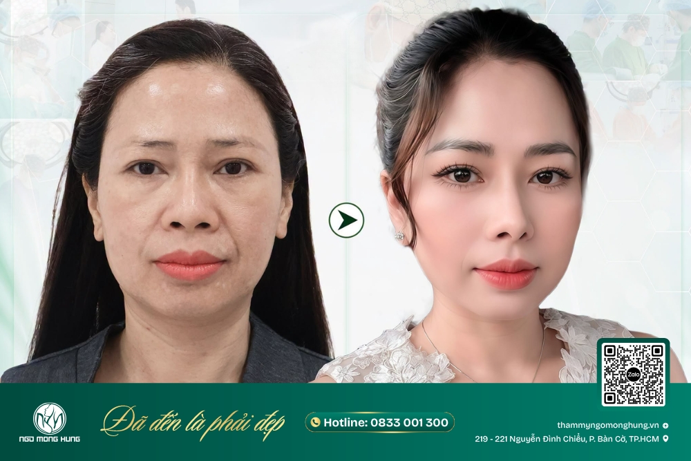 phẫu thuật nâng đuôi mắt