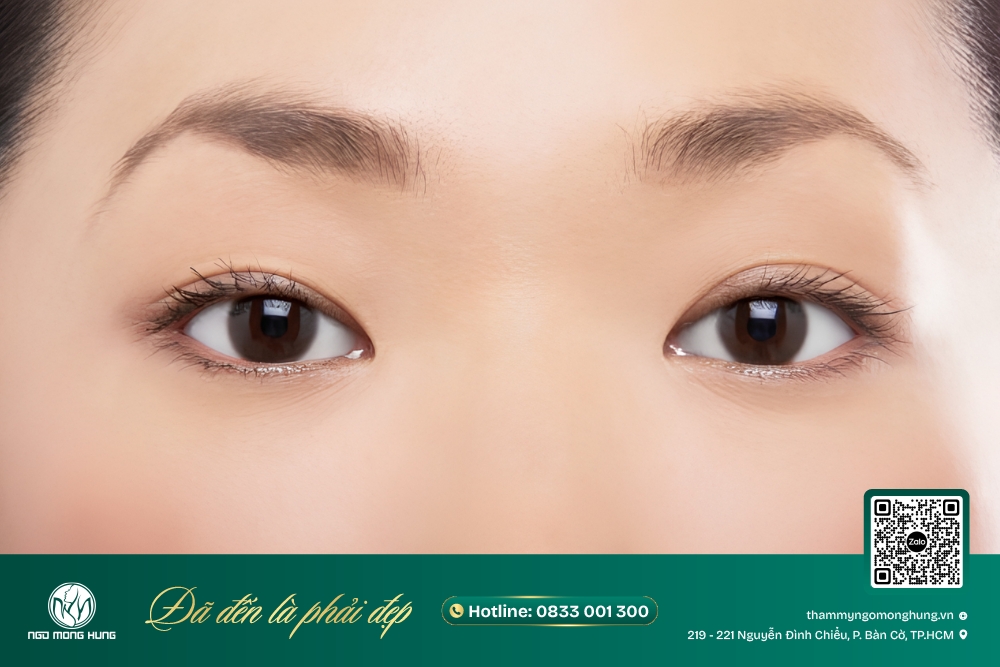 thẩm mỹ mắt cáo