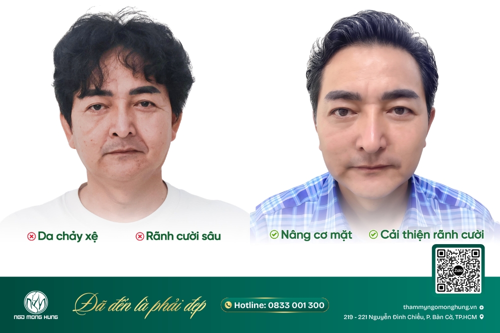 thẩm mỹ xóa nhăn vùng mắt