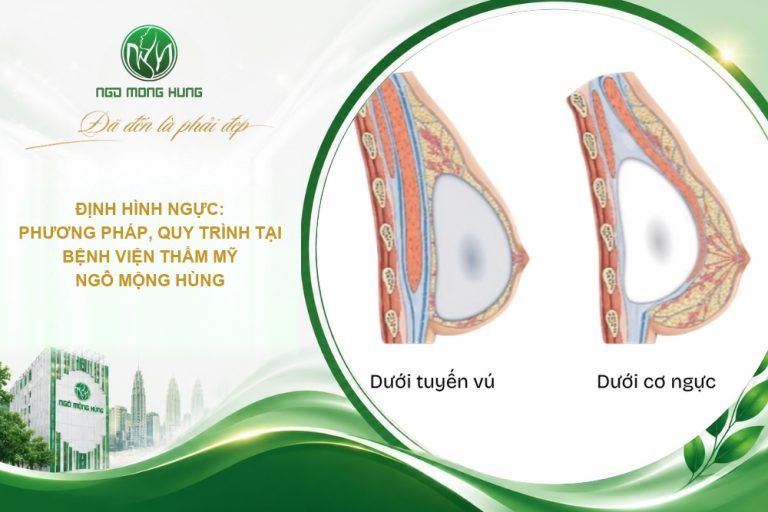 Định hình ngực