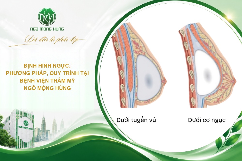 Định hình ngực sau phẫu thuật: Bí quyết lên form tại Bệnh viện Ngô Mộng Hùng