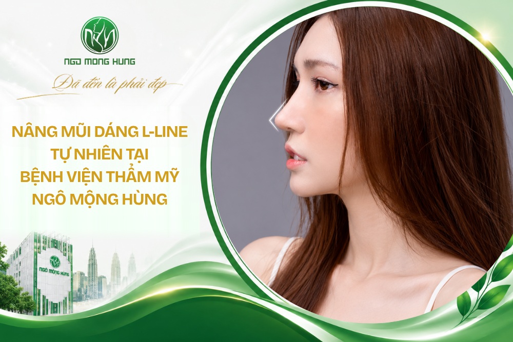 Nâng mũi dáng L-line tự nhiên tại Bệnh viện thẩm mỹ Ngô Mộng Hùng