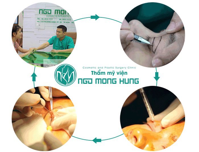 Cắt mỡ mắt trên| Bệnh viện thẩm mỹ Ngô Mộng Hùng