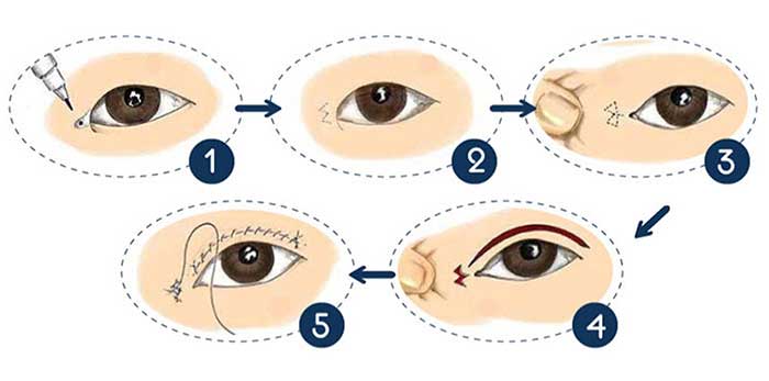 Cắt mí mắt xếch